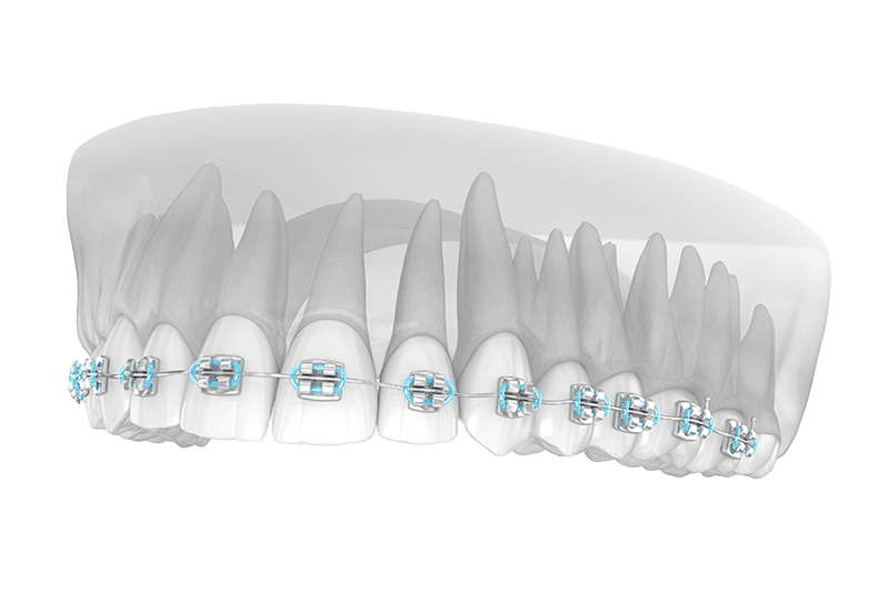 Coloured Braces, Types of Braces