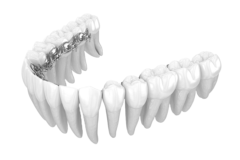 Lingual Braces – Behind Teeth