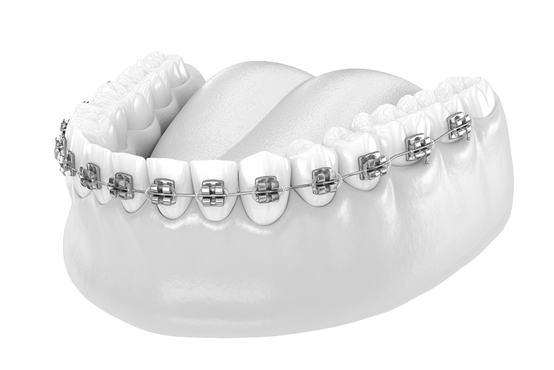 Conventional Metal Braces, Types of Braces