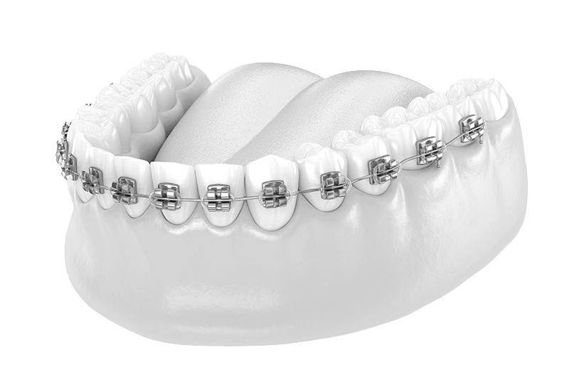 Types of Braces  Braces in Vancouver & Lower Mainland BC