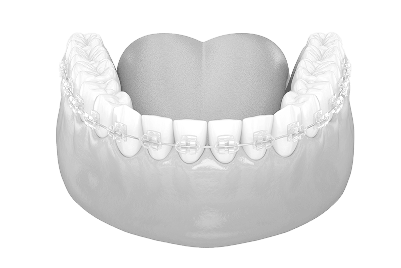 Translucent Cosmetic Braces  Greater Vancouver Orthodontics